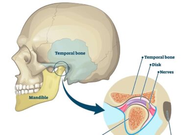 tmj-disorder